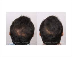 Biotin Hair Growth Before And After Pictures Men Hair Loss In Male Before After Results Hairmd Pune Hair Loss Men Hair Thinning At Crown Hair Loss Pictures