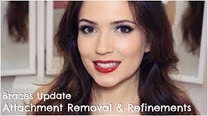 Stainless steel spiralizer attachment for kitchenaid mixer. Invisalign Attachments Removal Refinements Youtube