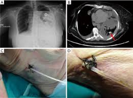 Image result for Small Caliber Chest Tube