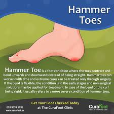Pin On Hammer Toes 101