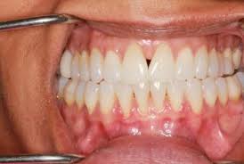 One of the most common causes of receding gums is periodontal disease. What Are Those Black Triangle Shaped Spaces Between My Teeth