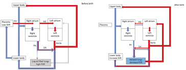 Image result for Delayed Transition from Fetal Circulation