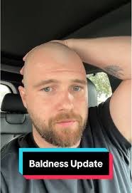 Experiencing Baldness: My Week Without Hair