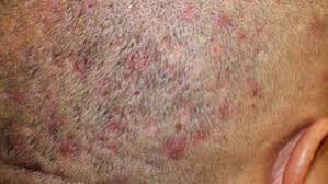 Image result for skin rash similar to scabies
