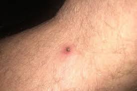 Image result for infected tick bite