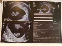 The number of fetuses and gestation sacs the presence of a heart beat Good News After No Embryo Seen At 6 5week Dating Scan July 2019 Birth Club Babycenter Australia