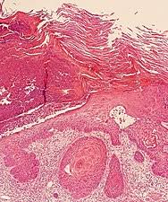 Squamous Cell Skin Cancer Wikipedia