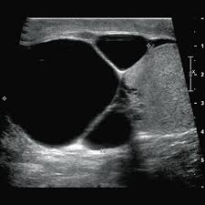 Partially replacing the right epididymis, this lump was consistent with a spermatocele. Tubular Ectasia Of Rete Testis