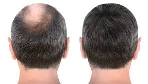 Four Top Benefits of Hair Transplants - Shear Pointe Hair Restoration  Detroit Michigan