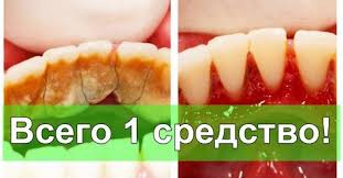 как убрать черные точки на зубах в домашних условиях Otlichnyj Sposob Izbavitsya Ot Zubnogo Kamnya Samomu I Doma Zdorovye Zuby Zubnoj Zdorovoe Pitanie