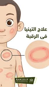 12 من أبرز طرق علاج التينيا نهائيا family guy fictional characters character