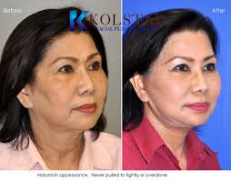 Asian face lift, brow lift, at plastic surgery sydney we provide best surgical and non surgical asian cosmetic surgery face lift. Asian Face Lift Before After Gallery Dr Kolstad San Diego Facial Plastic Surgeon