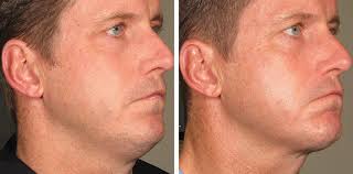 In a nutshell, it causes damage to the collagen layers of the skin and this in turn regulates new collagen. Ultherapy Philadelphia Skin Tightening Montgomery County