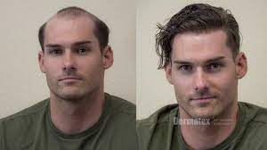 Mens Non Surgical Hair Restoration San Diego Orange County Ca Hair Loss Men Hair Restoration Hair Loss