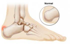 Haglund deformity is most common in young women who wear high heeled shoes or pumps. Haglund S Deformity Perform Podiatry