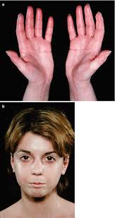 Image result for Connective Tissue Disorder
