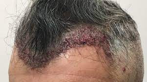 Il trapianto di capelli dopo 2 mesi · praticare sport come body building, mare e piscina · avrà vissuto il fenomeno dello shock loss · potrà . Croste Dopo Trapianto Di Capelli Cosa Bisogna Sapere Stefano Rogora