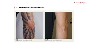 With a great environment built my great staffs and professionals, they never. Laser Machine For Tattoo Removal Quanta Systems