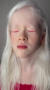 🩷🩷🩷🩷🩷 #albina #albinismo #albino