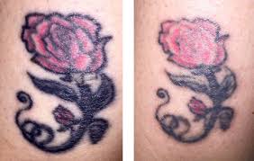 You can save money by purchasing multiple tattoo removal sessions up front. Forget The Misconceptions About Tattoo Removal