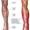 This guidance document focuses on the diagnosis and treatment of venous thromboembolism (vte). 1