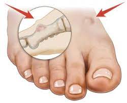 When this happens, it results in jaundice. Bone Tumor Of The Foot Symptoms And Causes