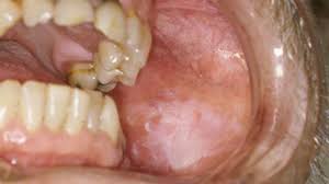Image result for Canker sores symptoms roof of the mouth