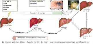We did not find results for: Hepatita C Se Vindeca 0758751841 Cabinet De Gastroenterologie Si Hepatologie Bucuresti