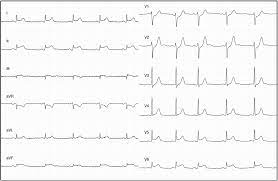 Tiene diferentes orígenes y aunque suele evolucionar favorablemente, también puede complicarse. Miocarditis Extensa Sociedad Espanola De Cardiologia