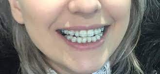 At dunn orthodontics, our free orthodontic consultations help scottsdale orthodontics patients get the care they need regardless of their age. 33f Day 3 Of Having Braces Hating It So Far Does It Get Better Braces