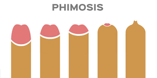 Image result for Phimosis