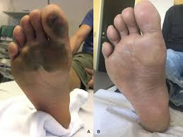 Frostbite can permanently damage the body. Case 2 Frostbite On Footsole Ilulissat Hospital A Frostbite Lesion 10 Download Scientific Diagram