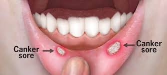 Image result for Canker sores symptoms roof of the mouth
