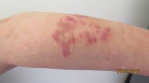 Learn more about the different types, causes, symptoms, diagnosis, treatment, and prevention of kaposi's sarcoma. Involution Of Classic Kaposi Sarcoma Lesions Under Acitretin Treatment Kaposi Sarcoma Treated With Acitretin Daadaa 2020 Clinical Case Reports Wiley Online Library