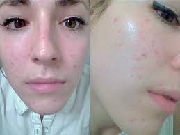As the name suggests, moderate acne is moderate—not mild, but not severe either. What It S Like To Take Accutane The Drug That Can Permanently Cure Acne Insider