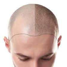 The loss of eyebrow hair can occur because of many reasons. Scalp Micropigmentation Michigan Michigan Fine Strokes Microblading Pmu Clinic