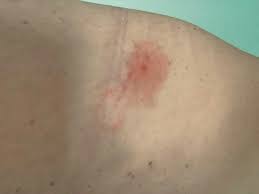 Image result for mite bites on humans