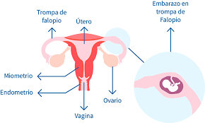 Embarazo Ectopico Embarazo Extrauterino