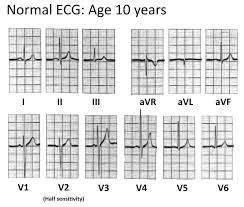 paediatric ecg interpretation litfl medical blog ecg