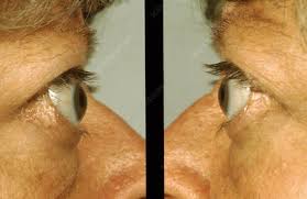 It is most often a sign of thyroid eye disease, but may also occur with cicatricial changes to the eyelid or congenital ptosis. Lid Lag Keyword Search Science Photo Library