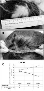 Trichotillomania is a disorder characterised by an irresistible urge to remove or pull one's own hair, which results in alopecia (hair loss). Pdf Trichotillomania Associated With A 25 Hydroxy Vitamin D Deficiency A Case Report Semantic Scholar