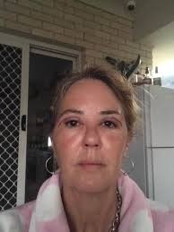 AnonPost2059 Gold Coast. Good evening, I am looking to have eyelid surgery  to remove droopy eyelids. I have researched online but many doctors have  great reviews with some not so great reviews.