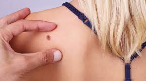 Image result for Merkel Cell Carcinoma