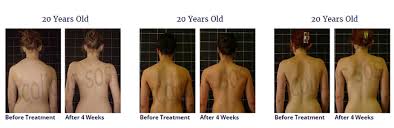 Dextroscoliosis varies widely in severity, and treatment ranges from observation to surgery. Scoliosis Treatment For A 20 Year Old