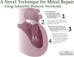 Mitral Valve Repair Using Adjustable Posterior Leaflet Neochords Jtcvs Techniques
