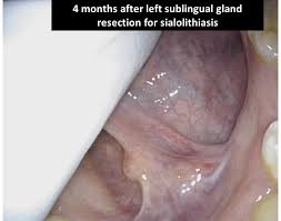 Image result for Sialolithiasis