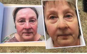 Sally Guy Annas (@skin_rejuvenator) • Instagram photos and videos