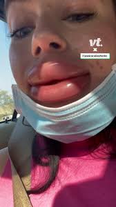 Lip Filler Gone Wrong 👄 😳