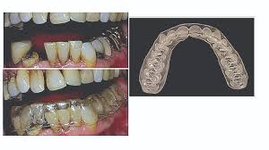 Start to mix the soda and peroxide together with a clean spoon. 10 Carbamide Peroxide A Gateway To Oral And Overall Health