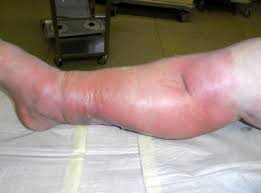 Image result for erysipel photos)